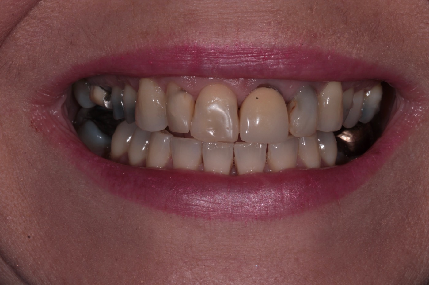 Heavily restored, discoloured front teeth, before
