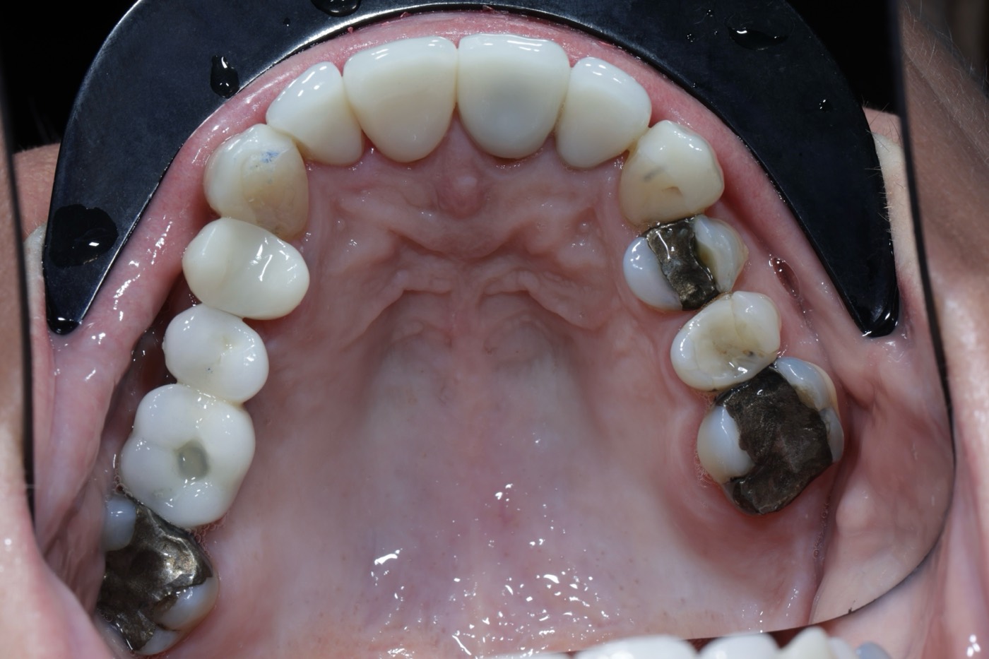 The same teeth restored, after