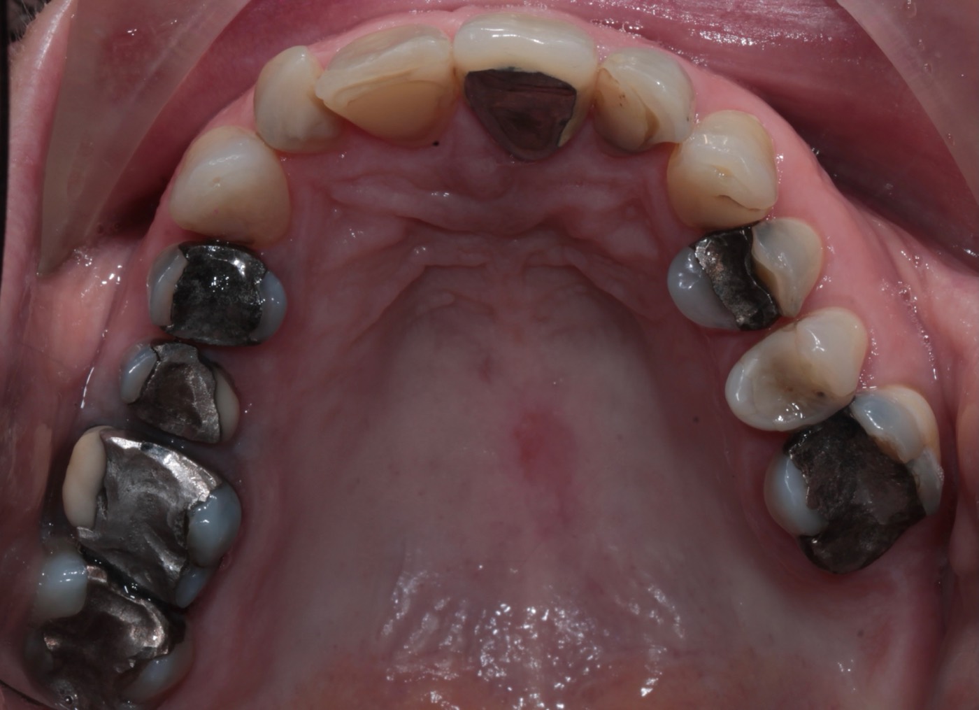 Back teeth with large old fillings, before