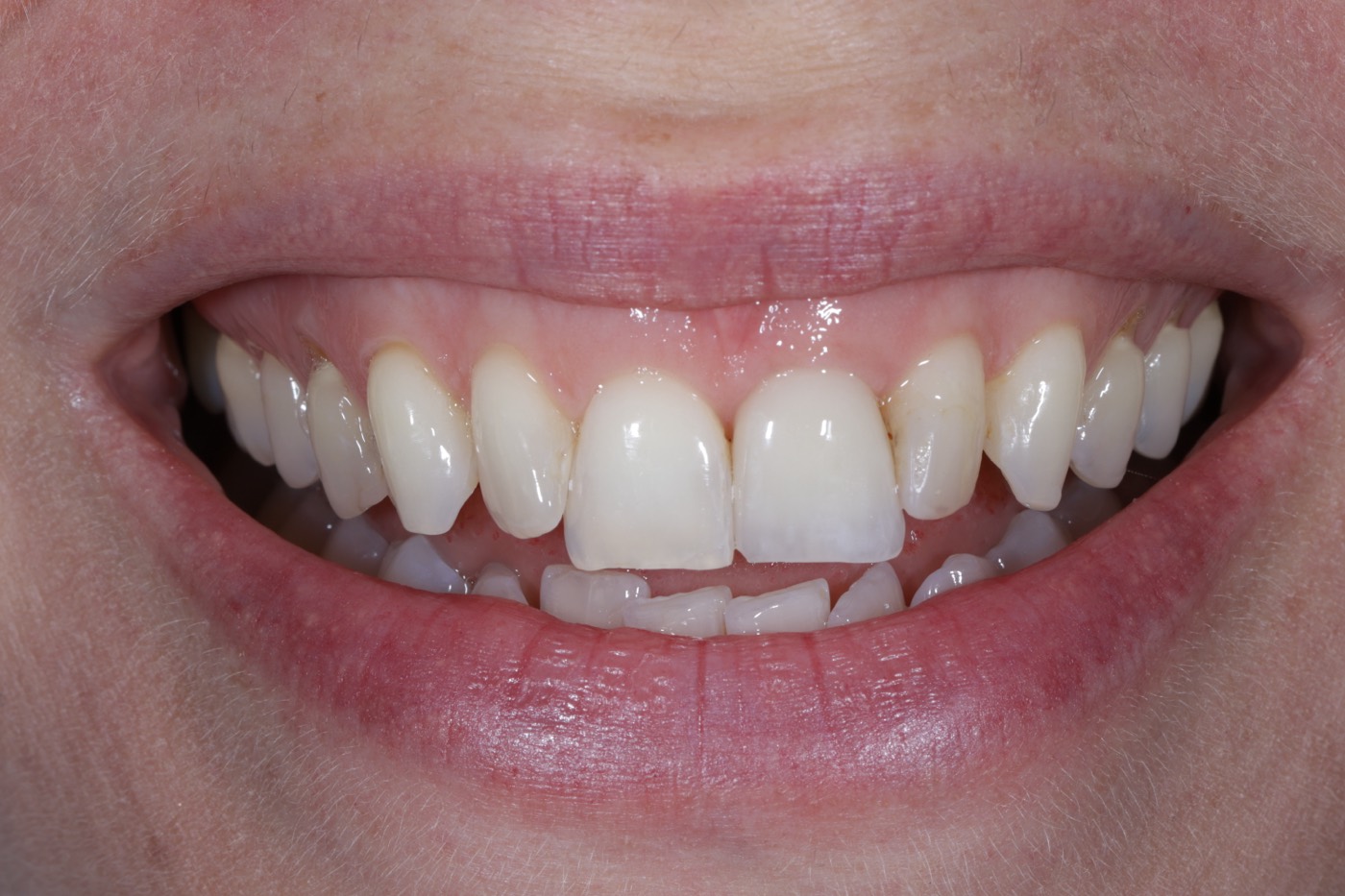 The same smile with an implant replacing the tooth