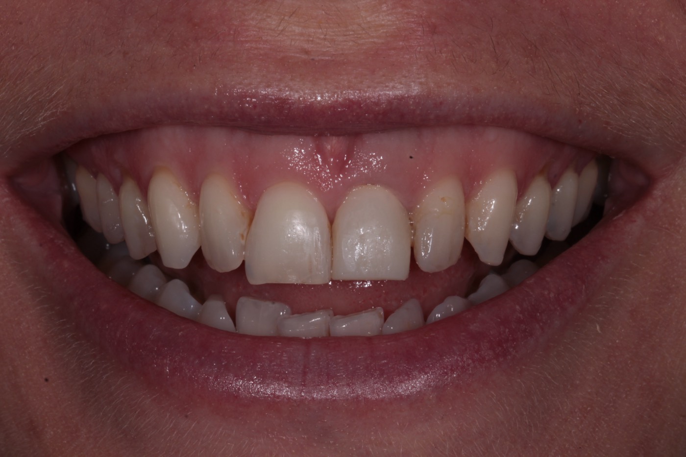 A front tooth before treatment