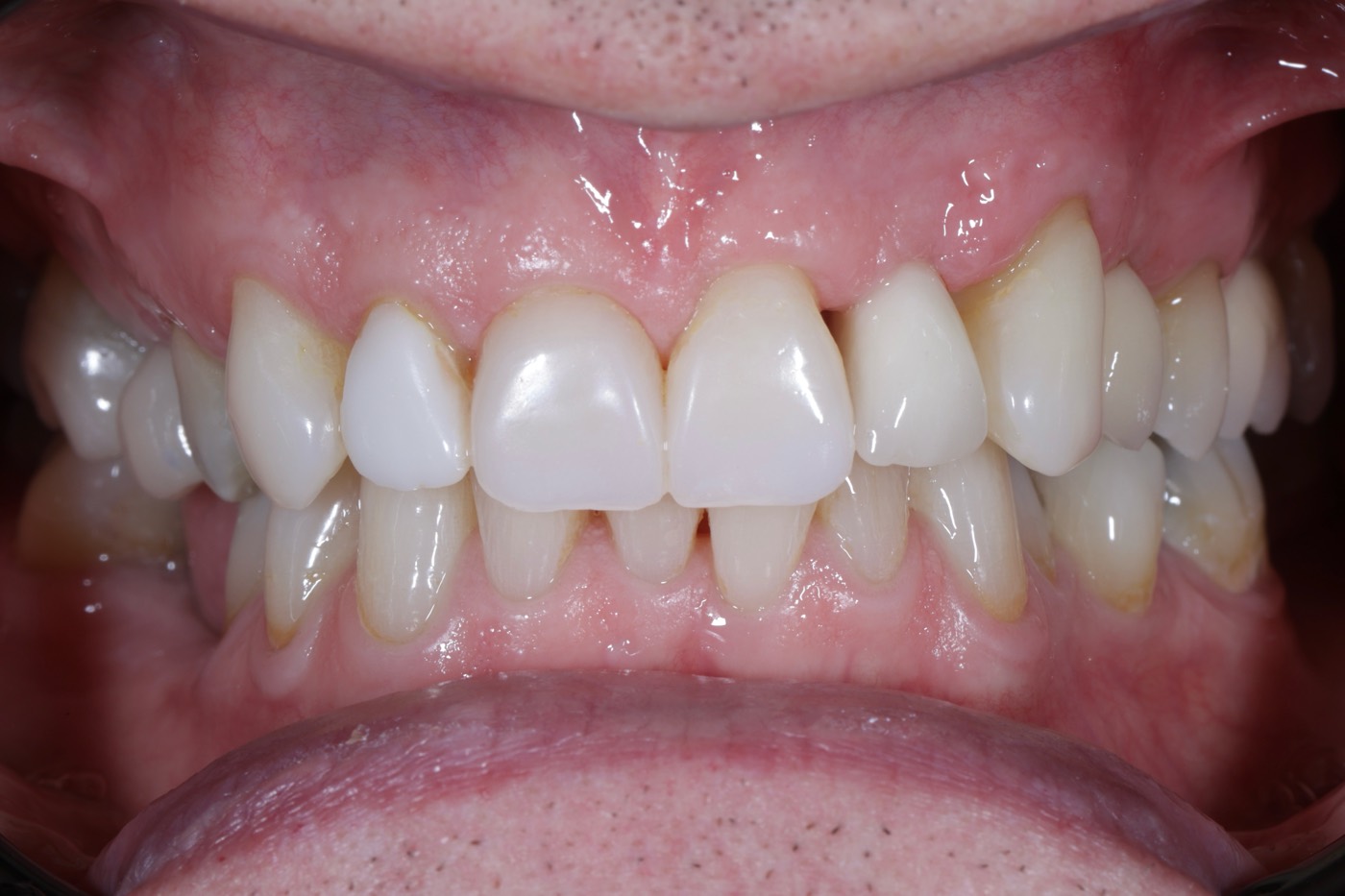 The same teeth rebuilt, after