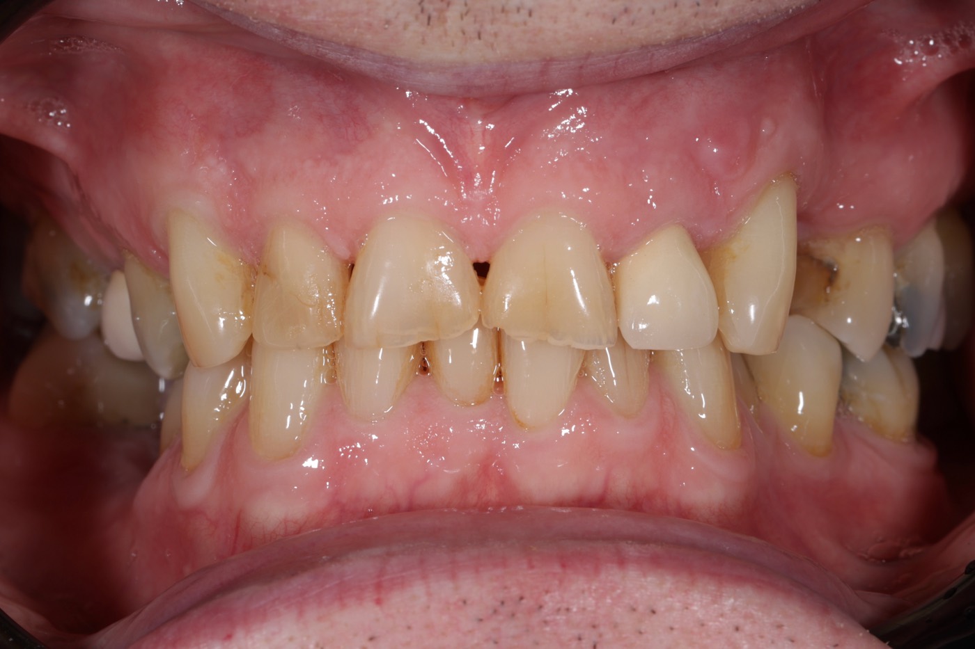 Worn and chipped teeth, before